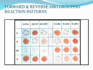 FORWARD & REVERSE ABO GROUPING
REACTION PATTERNS
 