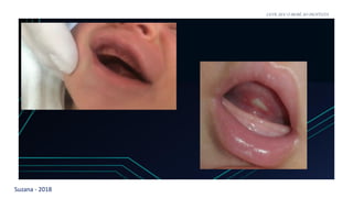 Suzana - 2018
LEVE SEU O BEBÊ AO DENTISTA
 