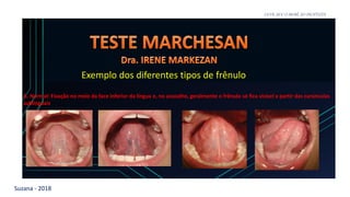 Suzana - 2018
LEVE SEU O BEBÊ AO DENTISTA
A. Normal: Fixação no meio da face inferior da língua e, no assoalho, geralmente o frênulo só fica visível a partir das carúnculas
sublinguais
Exemplo dos diferentes tipos de frênulo
 