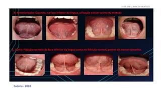Suzana - 2018
LEVE SEU O BEBÊ AO DENTISTA
B. Anteriorizado: Quando, na face inferior da língua, a fixação estiver acima da metade
C. Curto: Fixação no meio da face inferior da língua como no frênulo normal, porém de menor tamanho.
 