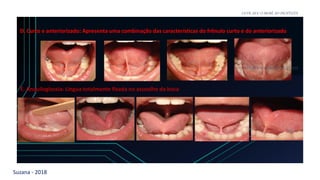 Suzana - 2018
LEVE SEU O BEBÊ AO DENTISTA
D. Curto e anteriorizado: Apresenta uma combinação das características do frênulo curto e do anteriorizado
LEVE SEU O BEBÊ AO DENTISTA
E. Anquiloglossia: Língua totalmente fixada no assoalho da boca
 