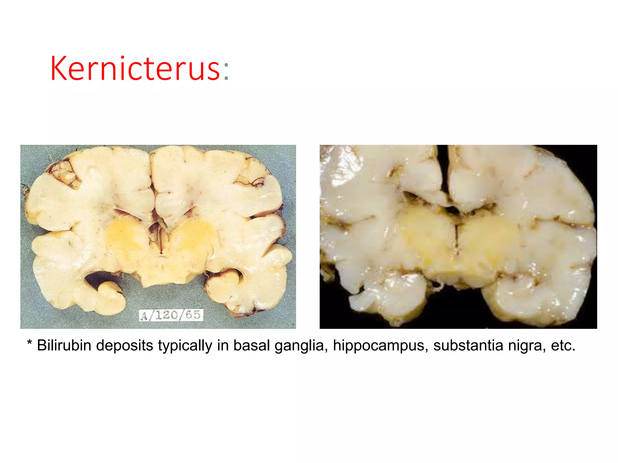 Kernicterus:
* Bilirubin deposits typically in basal ganglia, hippocampus, substantia nigra, etc.
 