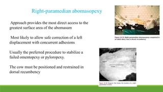 Approach provides the most direct access to the
greatest surface area of the abomasum
Most likely to allow safe correction of a left
displacement with concurrent adhesions
Usually the preferred procedure to stabilize a
failed omentopexy or pyloropexy.
The cow must be positioned and restrained in
dorsal recumbency
Right-paramedian abomasopexy
 