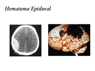 Hematoma Epidural
 