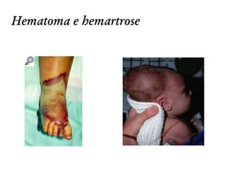 Hematoma e hemartrose
 