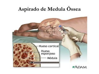 Aspirado de Medula Óssea
 