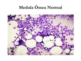 Medula Óssea Normal
 