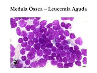 Medula Óssea – Leucemia Aguda
 