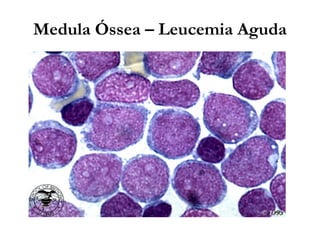 Medula Óssea – Leucemia Aguda
 