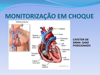 MONITORIZAÇÃO EM CHOQUE
CATETER DE
SWAN- GANZ
POSICIONADO
 