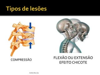 COMPRESSÃO 
Dalila Marcão 
FLEXÃO OU EXTENSÃO 
EFEITO CHICOTE 
 
