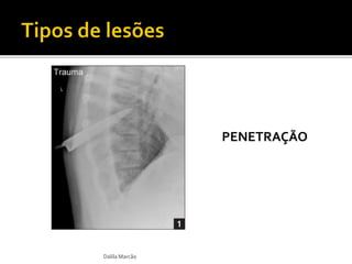 Dalila Marcão 
PENETRAÇÃO 
 