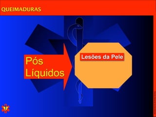 QUEIMADURAS




                 Lesões da Pele
      Pós
      Líquidos




                                  Escola Nacional de Bombeiros
 