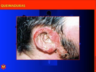 Escola Nacional de Bombeiros
QUEIMADURAS
 
