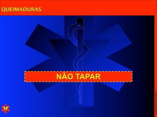 Escola Nacional de Bombeiros
              NÃO TAPAR
QUEIMADURAS
 