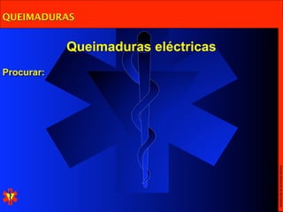 QUEIMADURAS


            Queimaduras eléctricas
Procurar:




                                     Escola Nacional de Bombeiros
 
