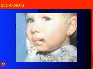 Escola Nacional de Bombeiros
QUEIMADURAS
 