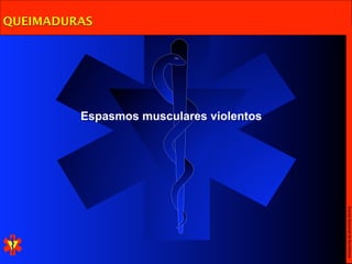 QUEIMADURAS




         Espasmos musculares violentos




                                         Escola Nacional de Bombeiros
 