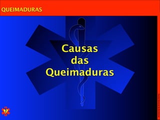 QUEIMADURAS




                Causas
                  das
              Queimaduras




                            Escola Nacional de Bombeiros
 