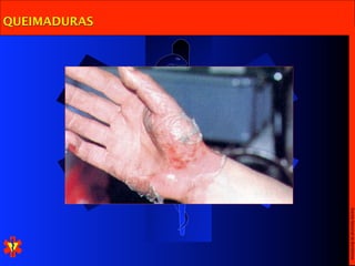 Escola Nacional de Bombeiros
QUEIMADURAS
 