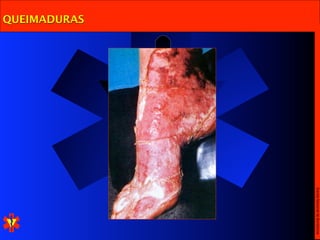Escola Nacional de Bombeiros
QUEIMADURAS
 