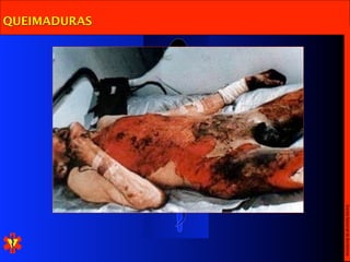 Escola Nacional de Bombeiros
QUEIMADURAS
 