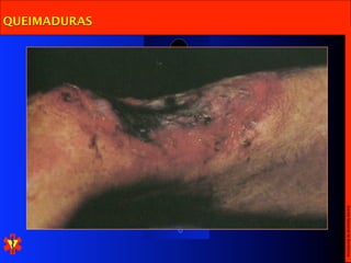 Escola Nacional de Bombeiros
QUEIMADURAS
 