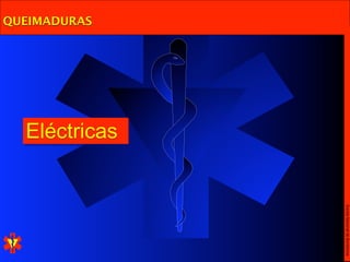 Escola Nacional de Bombeiros
              Eléctricas
QUEIMADURAS
 