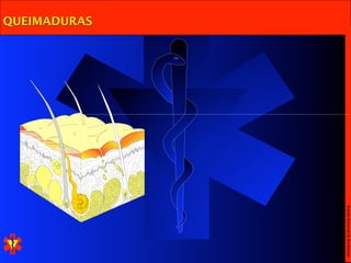 Escola Nacional de Bombeiros
QUEIMADURAS
 