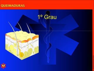 Escola Nacional de Bombeiros
              1º Grau
QUEIMADURAS
 