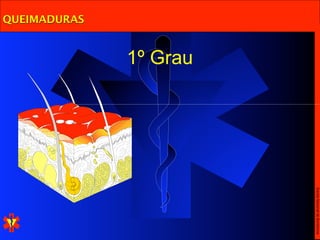 Escola Nacional de Bombeiros
              1º Grau
QUEIMADURAS
 