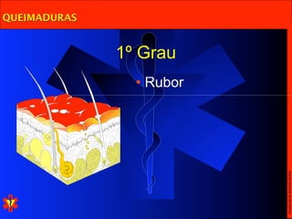 Escola Nacional de Bombeiros
                        • Rubor
              1º Grau
QUEIMADURAS
 