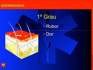 QUEIMADURAS


              1º Grau
                • Rubor
                • Dor




                          Escola Nacional de Bombeiros
 
