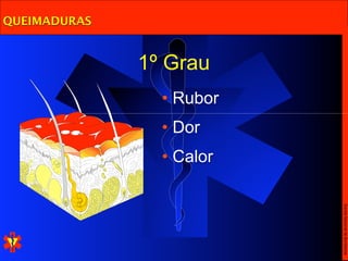 QUEIMADURAS


              1º Grau
                • Rubor
                • Dor
                • Calor




                          Escola Nacional de Bombeiros
 