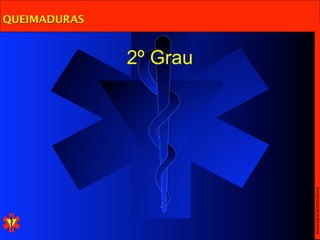 Escola Nacional de Bombeiros
              2º Grau
QUEIMADURAS
 