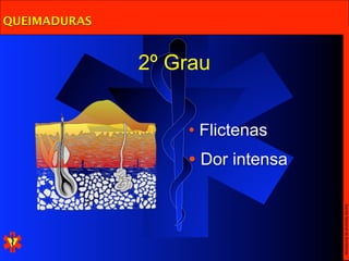 QUEIMADURAS


              2º Grau


                  • Flictenas
                  • Dor intensa




                                  Escola Nacional de Bombeiros
 
