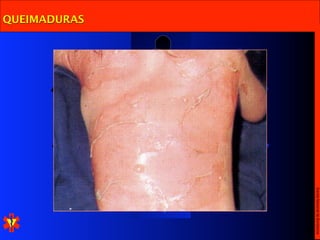Escola Nacional de Bombeiros
QUEIMADURAS
 