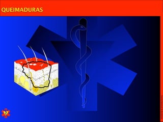 Escola Nacional de Bombeiros
QUEIMADURAS
 