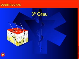 Escola Nacional de Bombeiros
              3º Grau
QUEIMADURAS
 