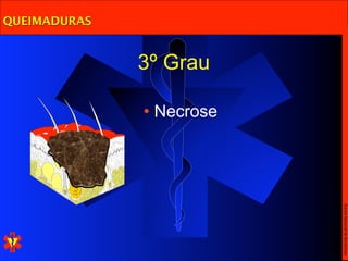 Escola Nacional de Bombeiros
                        • Necrose
              3º Grau
QUEIMADURAS
 