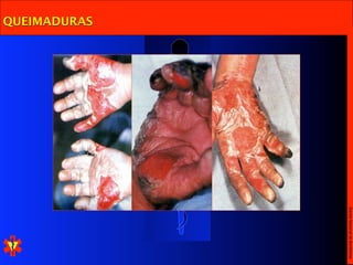 Escola Nacional de Bombeiros
QUEIMADURAS
 