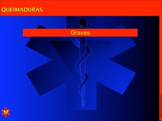 Escola Nacional de Bombeiros
              Graves
QUEIMADURAS
 