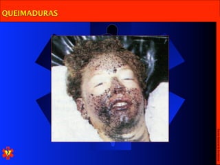 Escola Nacional de Bombeiros
QUEIMADURAS
 