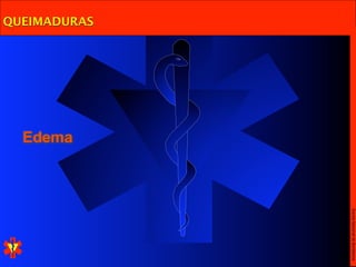 Escola Nacional de Bombeiros
QUEIMADURAS




              Edema
 