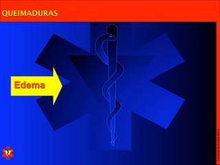 Escola Nacional de Bombeiros
QUEIMADURAS




              Edema
 