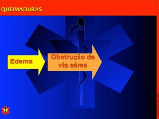 QUEIMADURAS




              Obstrução da
  Edema
               via aérea




                             Escola Nacional de Bombeiros
 