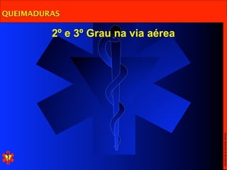 QUEIMADURAS

         2º e 3º Grau na via aérea




                                     Escola Nacional de Bombeiros
 