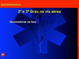 QUEIMADURAS

          2º e 3º Grau na via aérea

    •Queimaduras da face




                                      Escola Nacional de Bombeiros
 