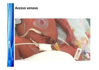 Acesso venoso
 