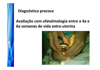 Diagnóstico precoce

Avaliação com ofatalmologia entre a 4a e
6a semanas de vida extra-uterina
 